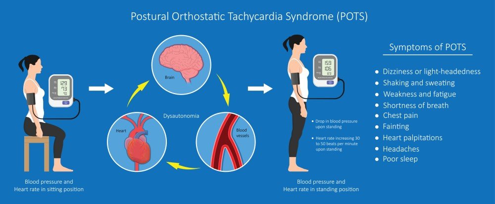 Postural Orthostatic Tachycardia Syndrome