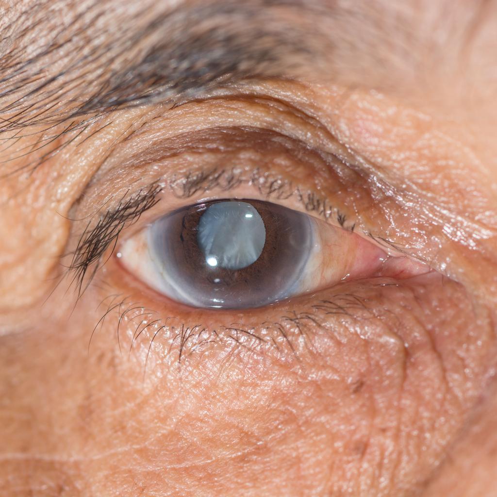  senile cataract