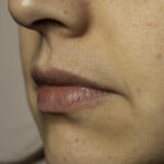 Young woman with rash on cheek close up