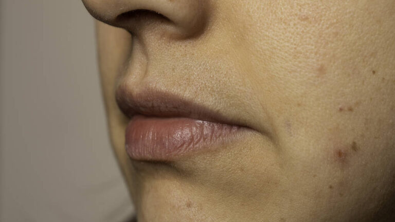 Young woman with rash on cheek close up