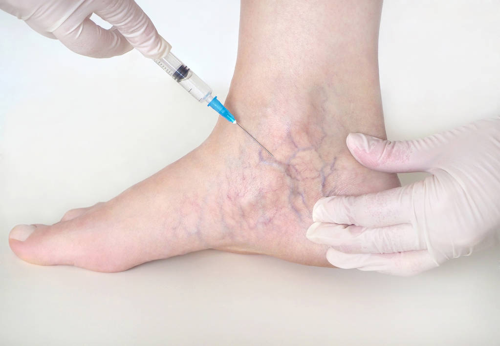 Sclerotherapy