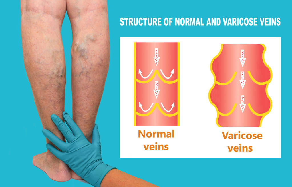 varicose vein treatment