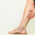 Varicose Vein