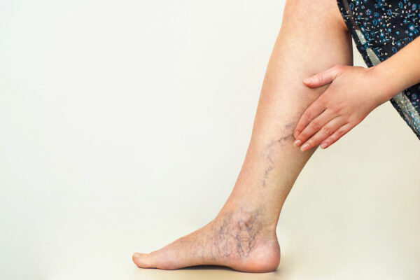 Varicose Vein Treatment Options Explained