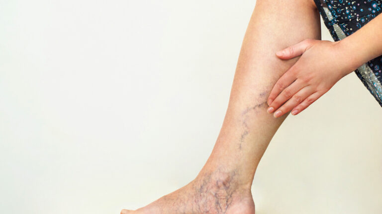 Varicose Vein